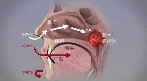 哪吒元素进入陕西医院腺样体面容科普海报