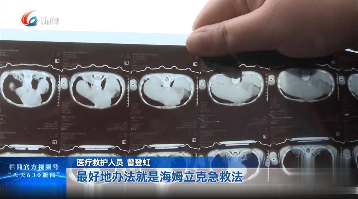 松子引发的危机：两岁宝宝生命垂危，家庭不堪重负