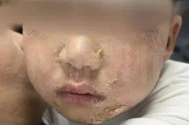 惊！吃火锅烫嘴3天后全身溃烂，病发原因与这些有关，吃火锅烫嘴引发全身溃烂，真相原来是这样！