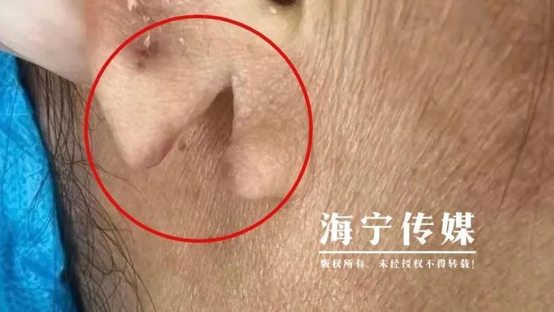 意外！海宁黄女士戴耳环耳垂裂开事件，40多岁黄女士的遭遇：耳环掉落耳垂撕裂之痛