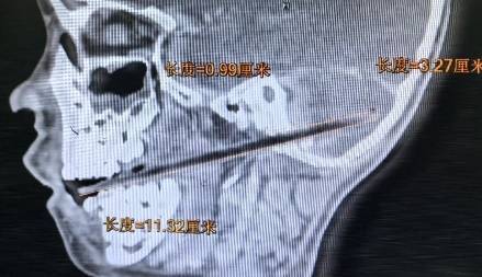 竹签穿颅危机！中山一院成功救治6岁患儿