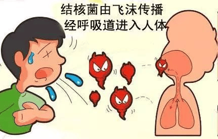关注肺结核：症状特征、传播路径与治疗警示，揭秘肺结核：典型症状、传播途径与治疗要点