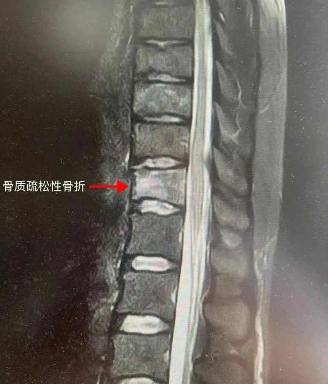 惊！25岁女孩捡衣骨折，背后原因竟是长期喝咖啡，25岁小张捡衣骨折：咖啡与不健康生活的隐患