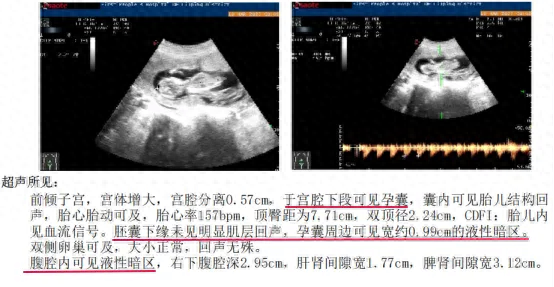 惊险！年轻女子子宫破裂，疤痕妊娠危害知多少？，过年有月经竟怀孕14周，疤痕妊娠险夺年轻女子性命