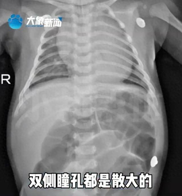 52天宝宝肉毒杆菌中毒：蜂蜜水背后的危险，仅52天宝宝病危，竟因蜂蜜水中毒！