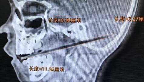 筷子刺颅危机四伏，中山一院与死神抢人成功 惊险！筷子贯穿颅底，小患者在中山一院重获新生