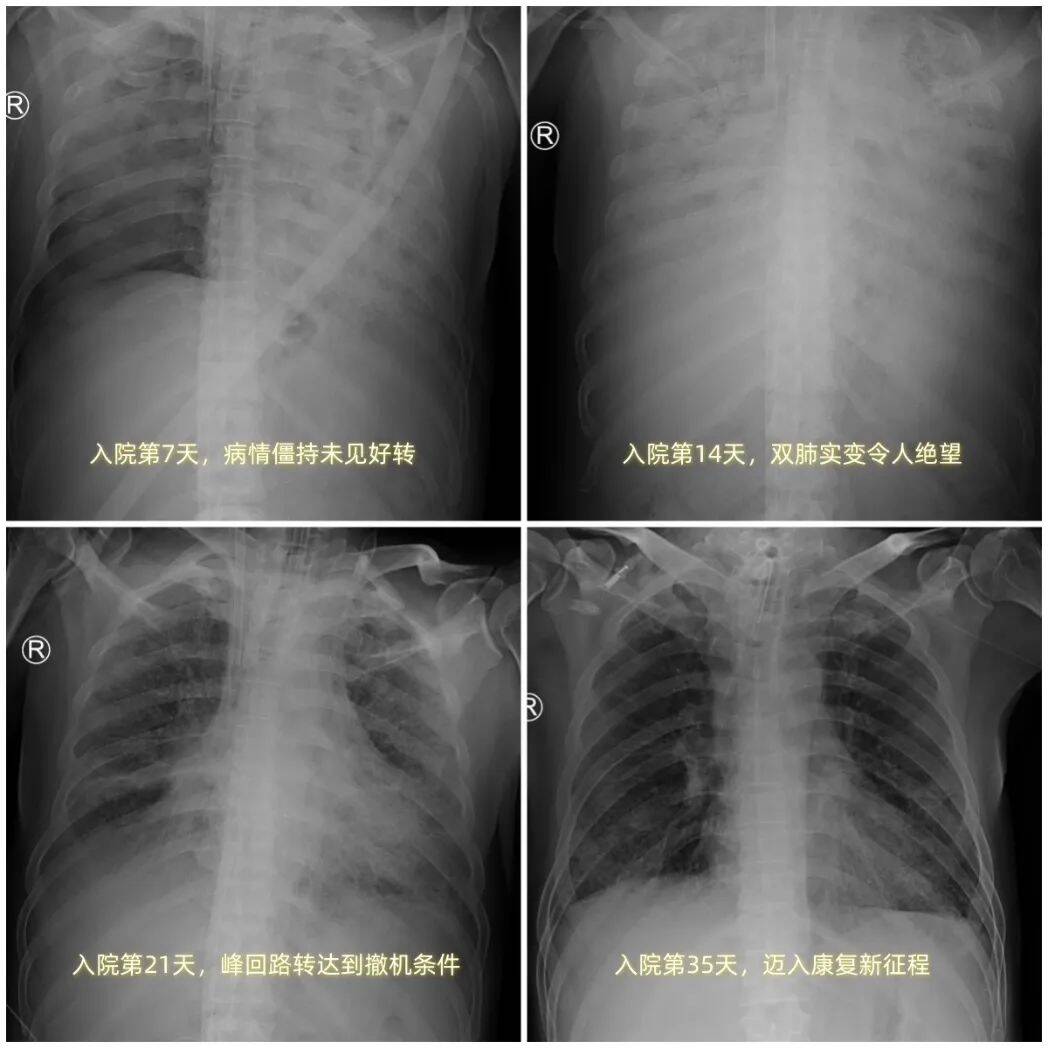 长程VV ECMO显神威！山东省公卫中心成功救治重症流感“大白肺”患者，从“命悬一线”到“康复出院”，山东省公卫中心ECMO技术创造生命奇迹
